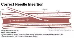 输液手淤青怎么快速恢复,输液淤青用土豆片有效吗