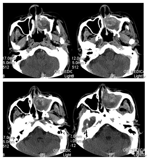 73岁患者因左鼻塞流脓涕4个月入院，CT发现一软组织高低混杂密度，怎么诊断？