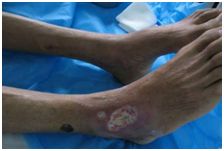 康复疗法,北京国医火针疗法视频