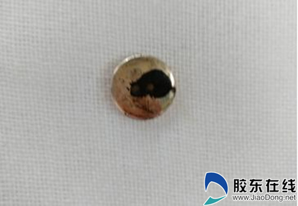 宝宝误吞硬币无痛胃镜取出,幼儿胃镜取异物全过程