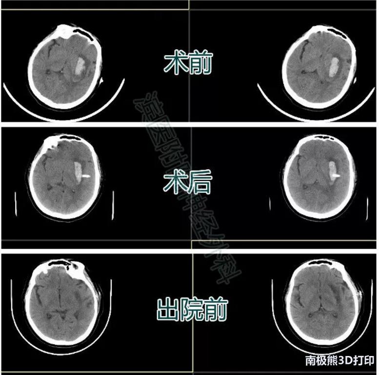 3D打印在脑出血治疗中的应用