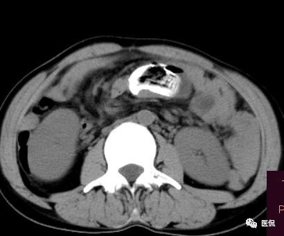 手术纱布遗留在体内可以吸收吗,手术纱布忘了取出会怎样