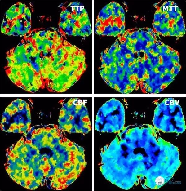 天坛医院做椎动脉狭窄多少要手术,天坛椎动脉狭窄