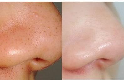 祛黑头的小窍门简单有效,祛黑头小技巧快来看看