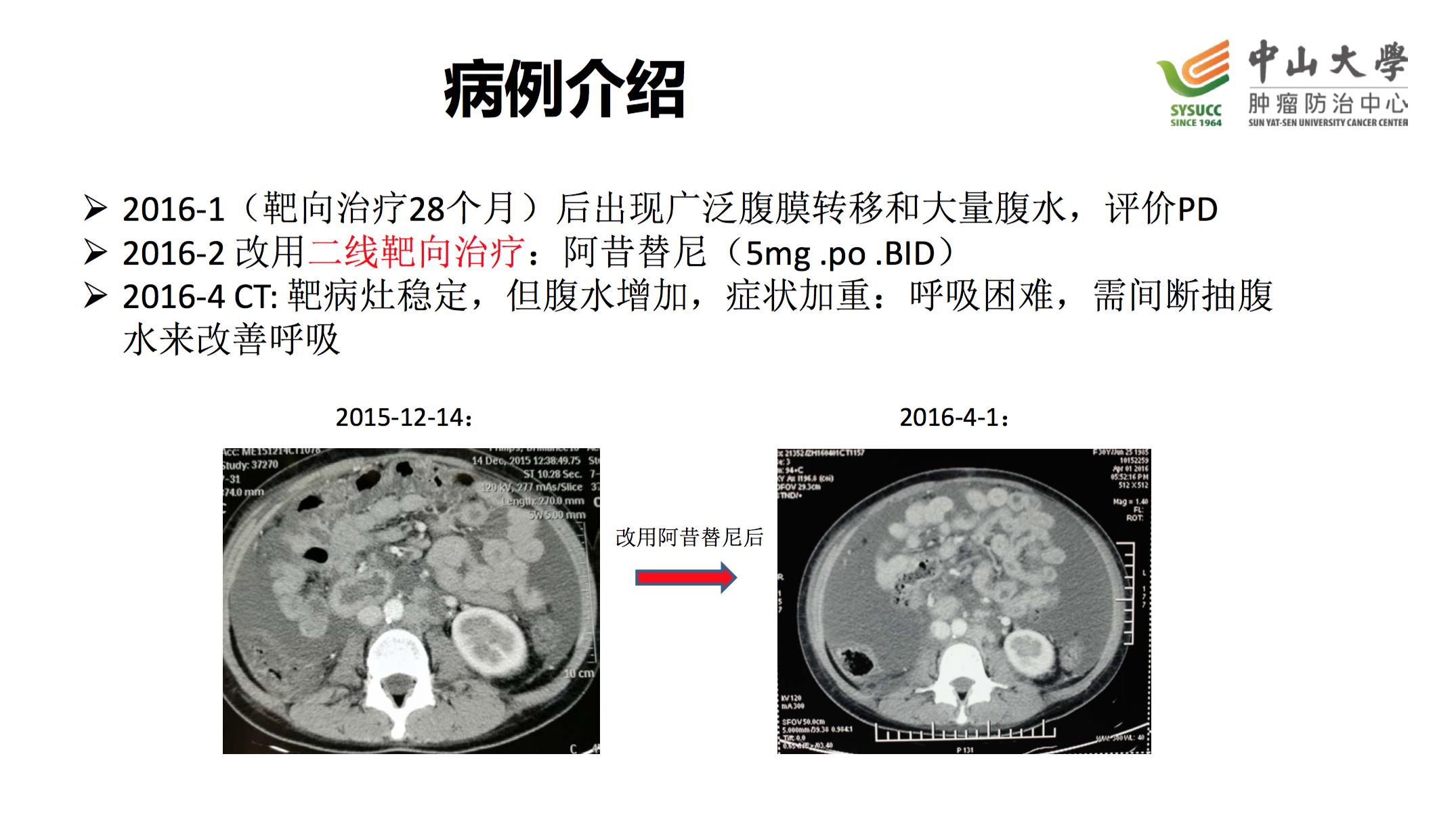 阿昔替尼联合单抗效果好吗,阿昔替尼联合免疫治疗肾癌