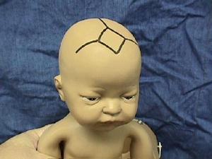 婴儿的囟门小说明什么,婴儿的囟门偏小