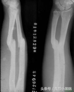 脚踝骨折取钢板后还用打石膏吗,距骨骨折固定钢板后多久拆除石膏