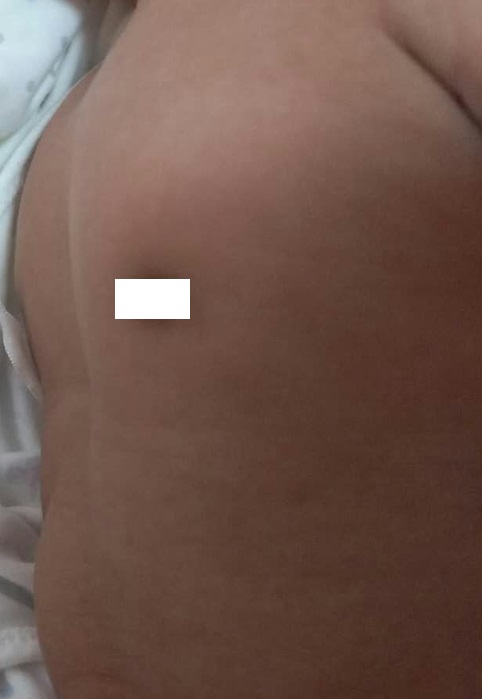 桶状胸手术,先天性桶状胸