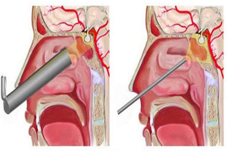 长了脑垂体瘤该怎么办？