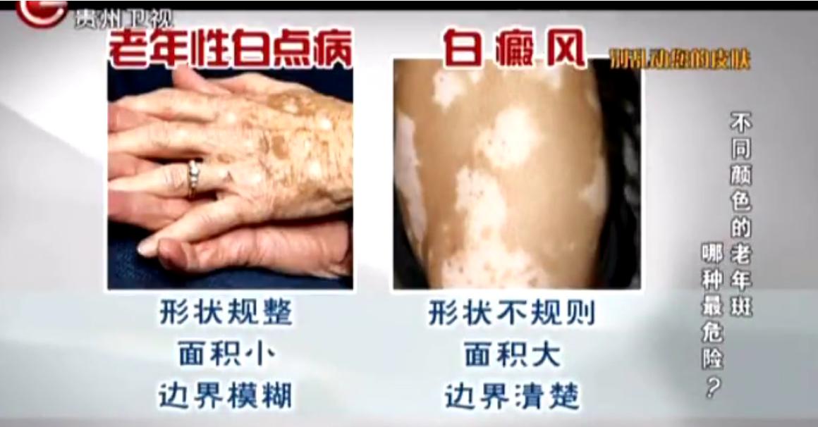 云南白药，黑人等牙膏去老年斑真的靠谱吗？哪种老年斑最危险？
