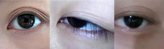 割双眼皮变成三眼皮如何修复,双眼皮修复完变三眼皮