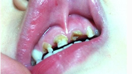 奶瓶齿补救方法,幼儿奶瓶齿怎么修