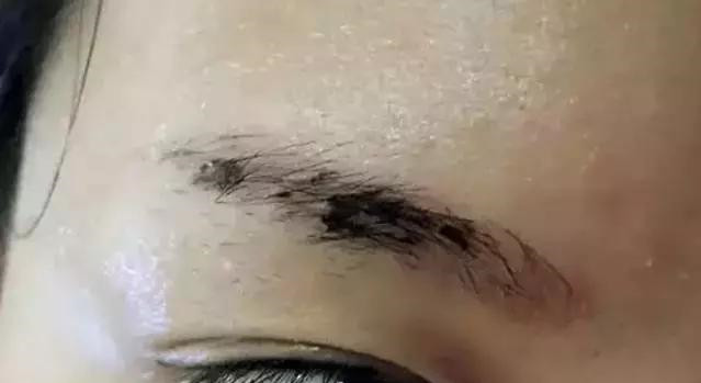 怎么让眉毛快速结痂掉痂,眉毛结痂掉痂修复过程