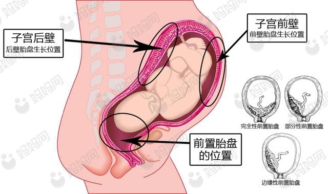 前置胎盘和前壁胎盘22周能查到吗,前壁孕24周胎盘低置是前置胎盘吗