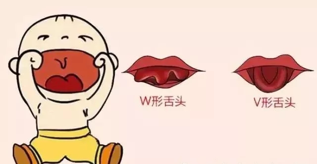 小孩说话不清楚剪舌根多久恢复,儿童说话正常舌筋有没有必要剪