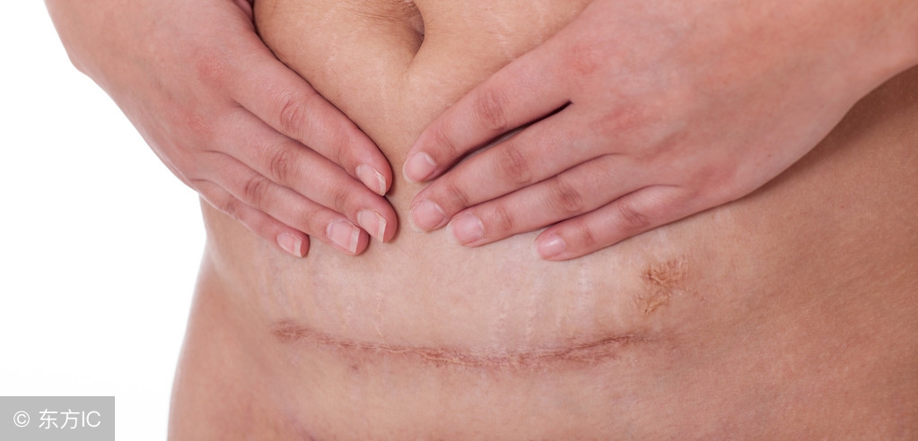 怎么消除剖腹产的疤痕,剖腹产的疤痕避免了心灵的创伤