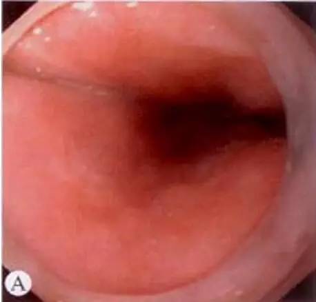 早期食管癌用内镜可以根除吗,超声内镜可以查出早期食管癌吗