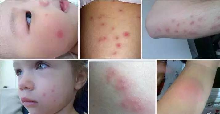 家庭必备止痒药,家庭常备儿童止痒药