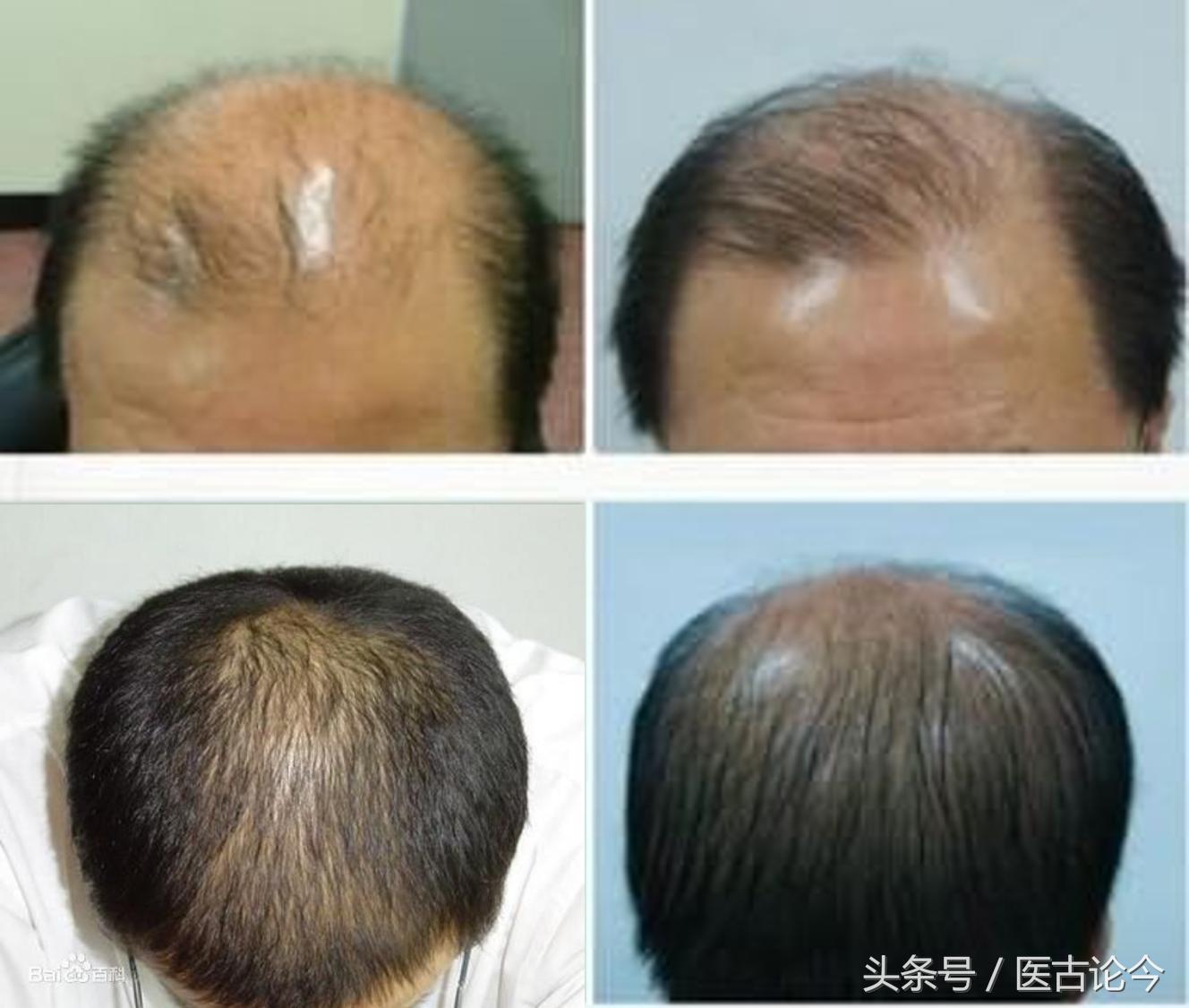 肾虚脱发肾好了会不会长出来,肾虚导致的脱发有什么特点