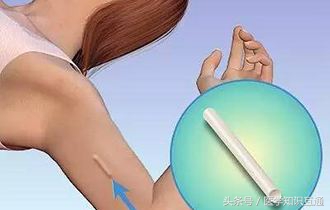 避孕方式排行榜,哪种女人最舒服最安全?