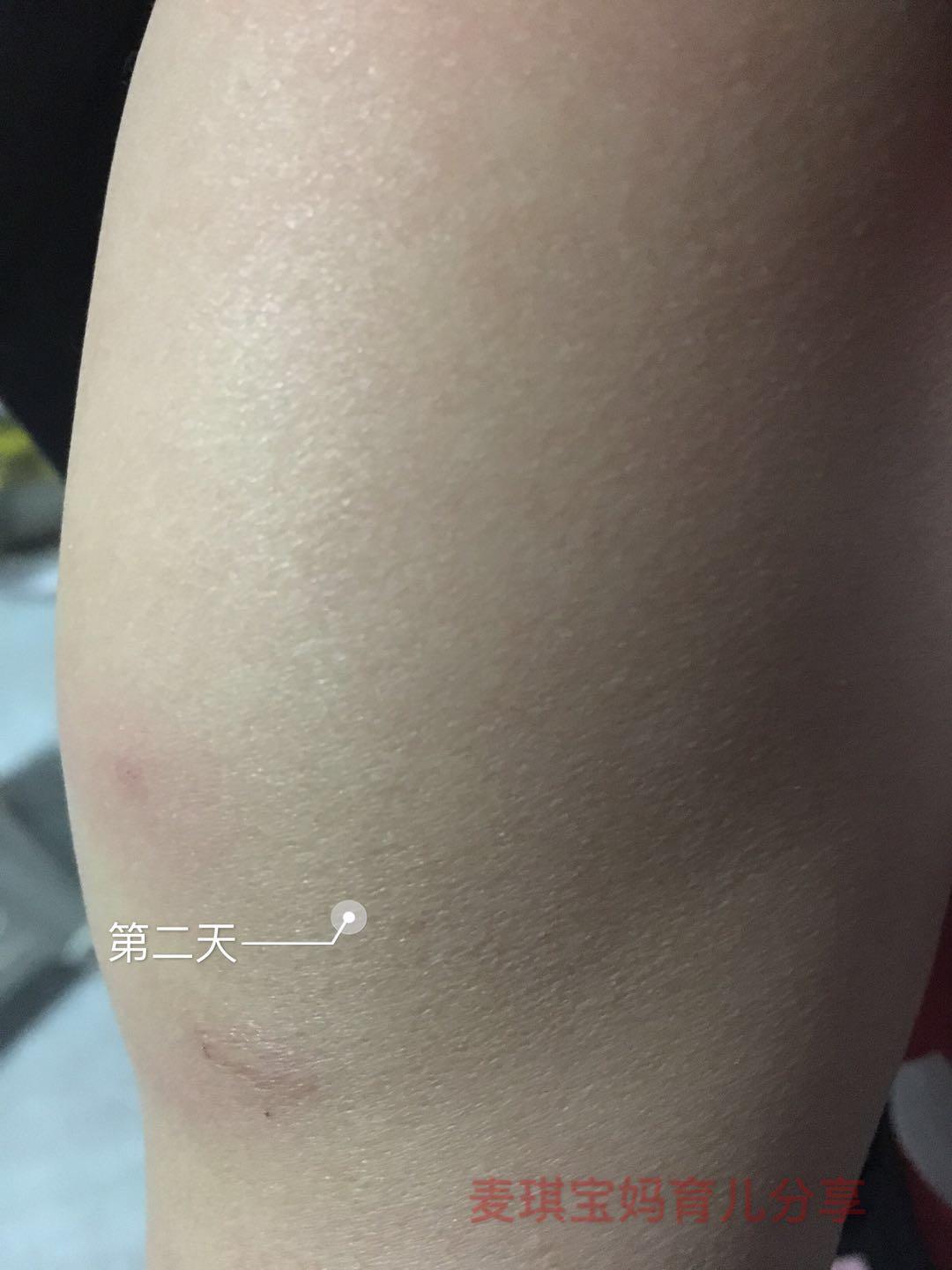 孩子打了百白破胳膊上有硬块,宝宝打完百白破胳膊肿了怎么回事