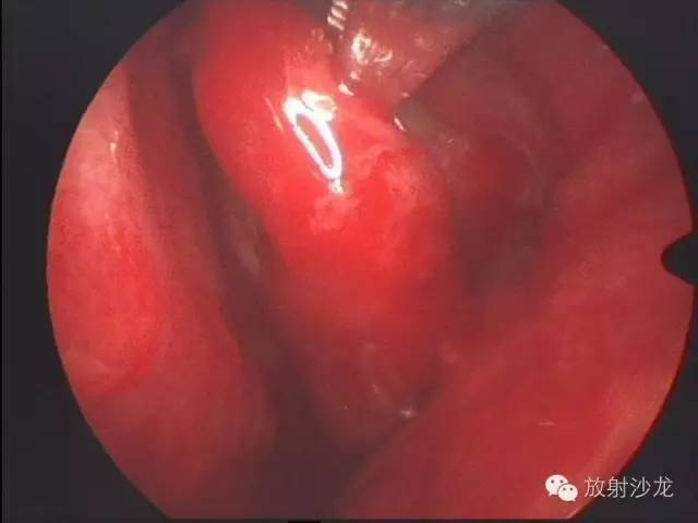 巨细胞性肉芽肿治疗费用,颌骨巨细胞修复性肉芽肿x线表现