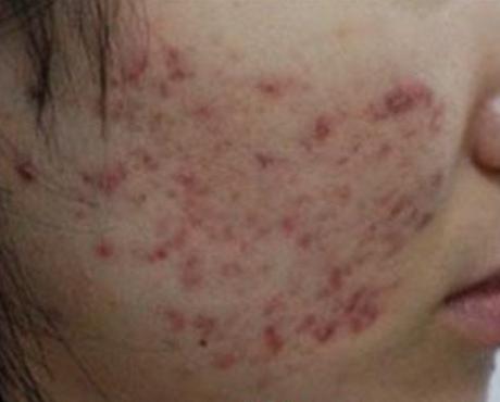 脸上红色痘印一直不消,脸上有红色痘印怎么祛除