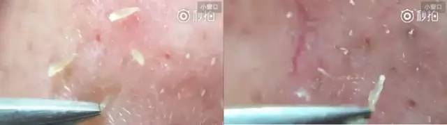 长痘痘怎么才能不留印,长痘痘了怎么消除不留疤