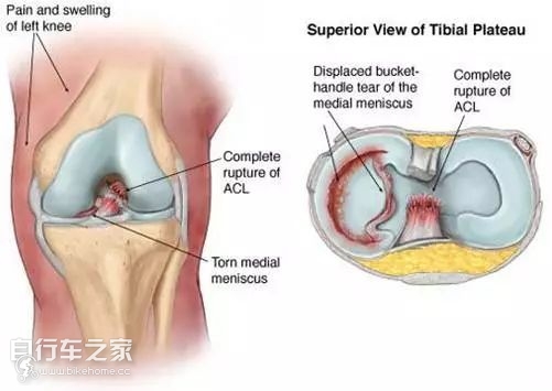 骑行导致膝盖响怎么治疗,骑行膝盖内侧疼的原因