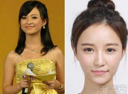 平行双眼皮割成了欧式双眼皮,割了个欧式双眼皮