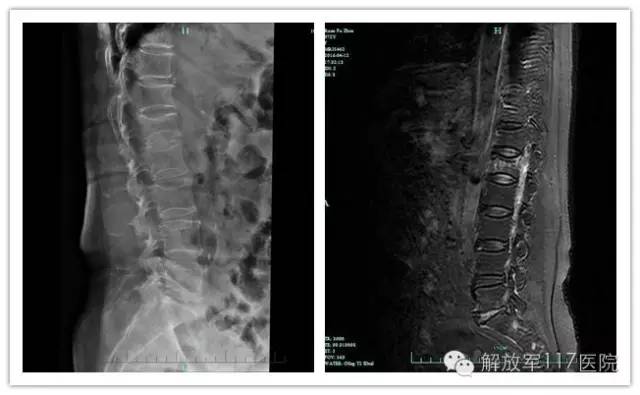 老人91压缩性骨折的最佳治疗方法,80岁老人11椎体压缩骨折怎么治疗