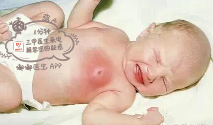 被宝宝压成乳腺炎,新生儿挤乳房得乳腺炎