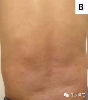 皮肤科专家谈论银屑病生物制剂,中国治疗银屑病新药生物制剂