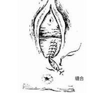 顺产侧切有什么影响？如何恢复已经全部总结验收？
