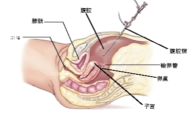 子宫内膜异位症健康宣教三折页,预防子宫内膜异位症的健康教育