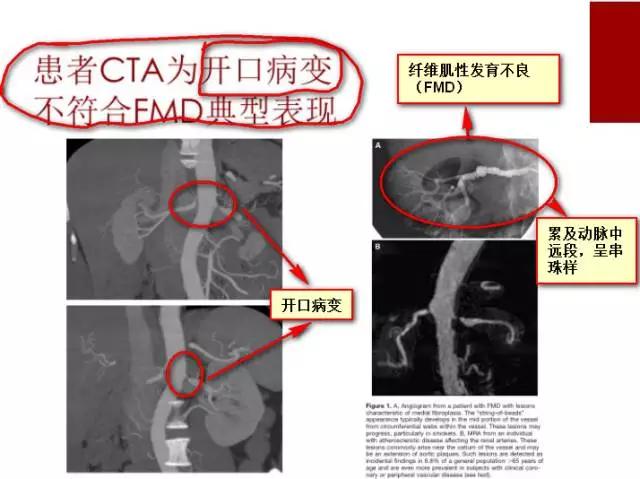 28岁出现高血压，恐怕没这么简单！