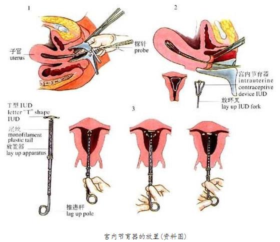 你被逼上环了吗？女性上环全过程，简直就像命案现场！
