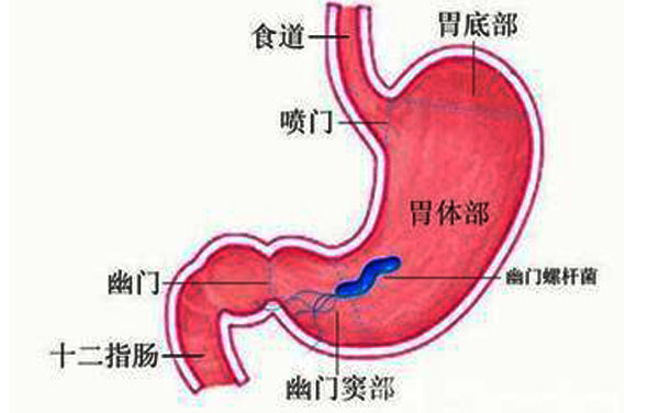 得了幽门螺旋杆菌就是胃癌对吗,感染幽门螺旋杆菌多久变成胃癌