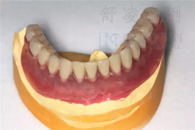 活动假牙戴不住，种植牙又嫌贵该怎么办？