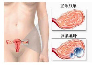 第一次查出卵巢囊肿,卵巢囊肿最简单自愈方法