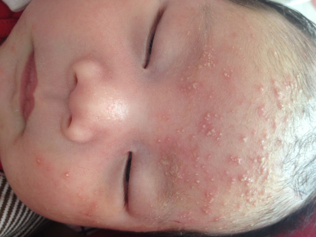 鸡蛋牛奶小麦大米过敏的宝宝辅食,过敏宝宝辅食添加时间顺序和种类