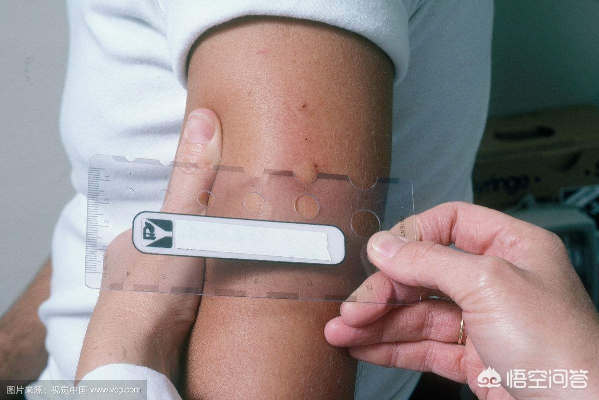 支气管哮喘能根治吗有什么方法,支气管哮喘能不能彻底治愈