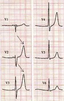 “有声播报”第三期│T波高尖，可能会是哪些疾病？
