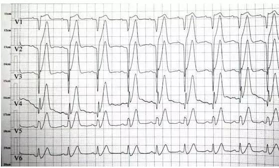 “有声播报”第三期│T波高尖，可能会是哪些疾病？