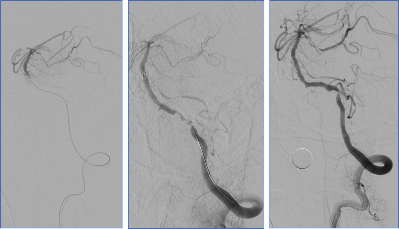 缺血性脑卒中术后管理,急性缺血性脑卒中血管内治疗