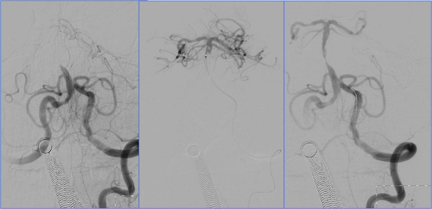 缺血性脑卒中术后管理,急性缺血性脑卒中血管内治疗