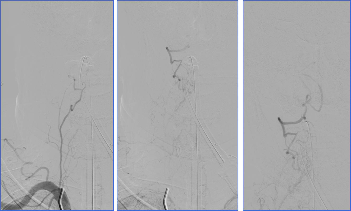 缺血性脑卒中术后管理,急性缺血性脑卒中血管内治疗
