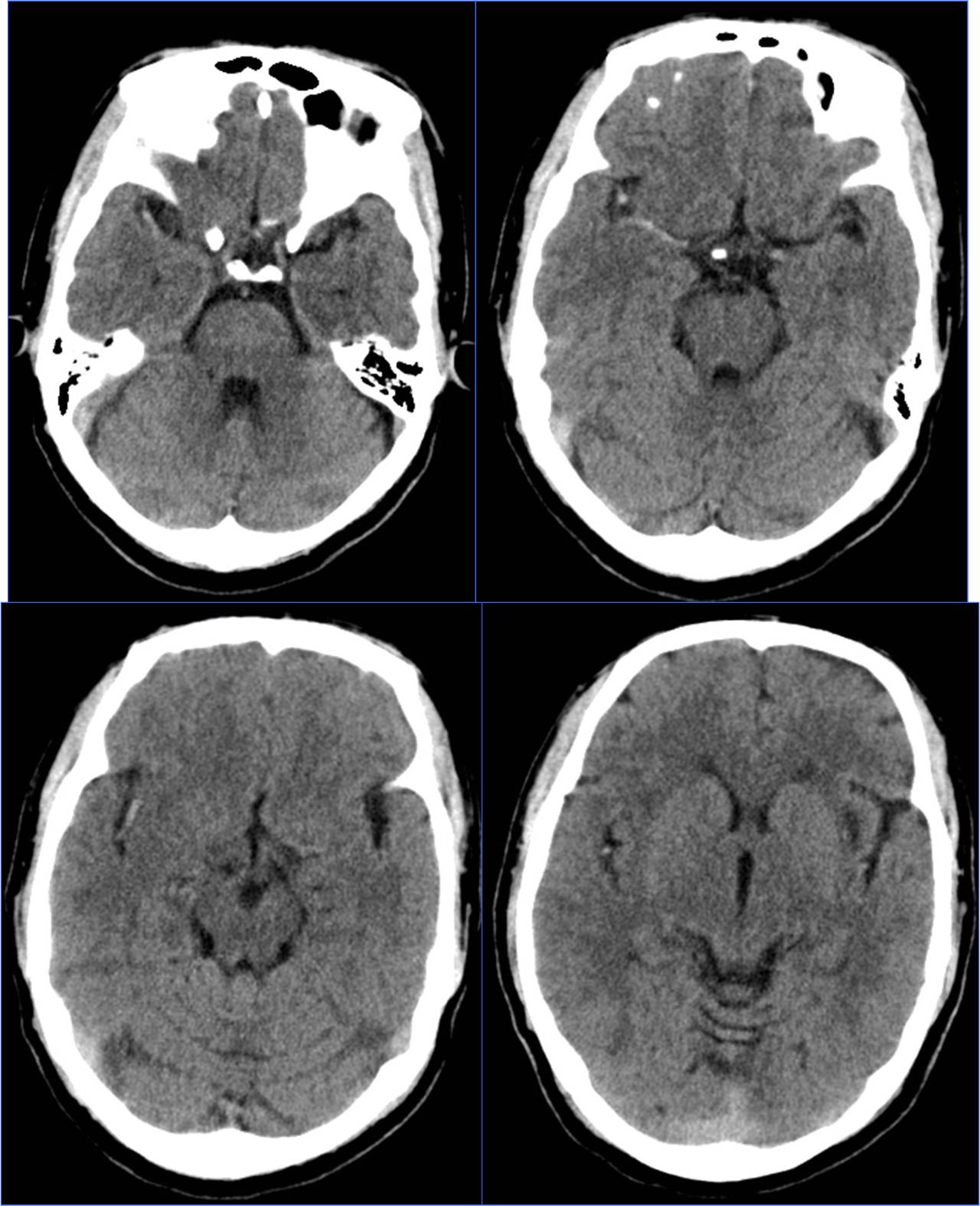 缺血性脑卒中术后管理,急性缺血性脑卒中血管内治疗