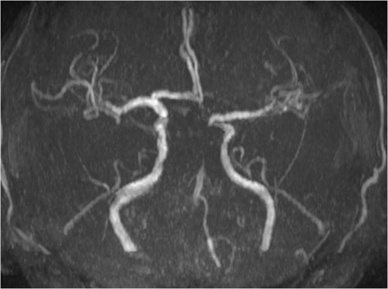 缺血性脑卒中术后管理,急性缺血性脑卒中血管内治疗