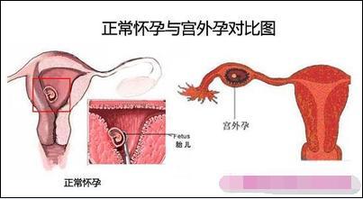 上环所有女性都有副作用,女性上环会引起皮肤差吗